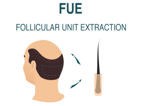 Hair transplant FUE Method