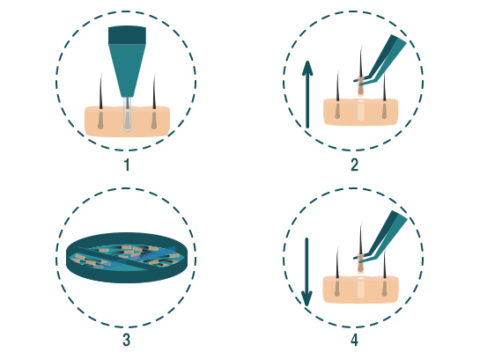 Hair transplant FUE Method 2