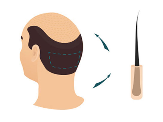 Hair Transplant Fue Technique