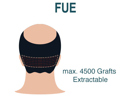 Hair Transplant Fue Technique