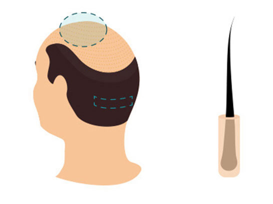 Hair Transplant Fut Technique