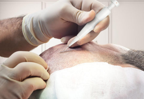 Hair transplant DHI