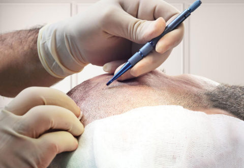 Hair Transplant Sapphire Method