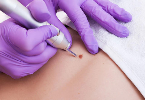 Skin Tag Removal istanbul