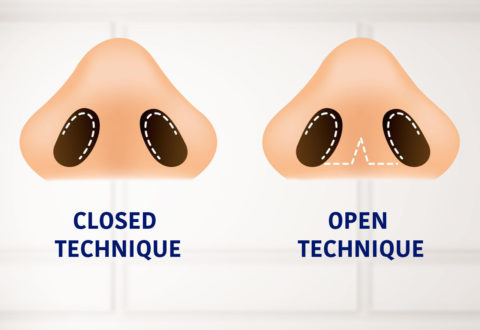 Rhinoplasty Turkey